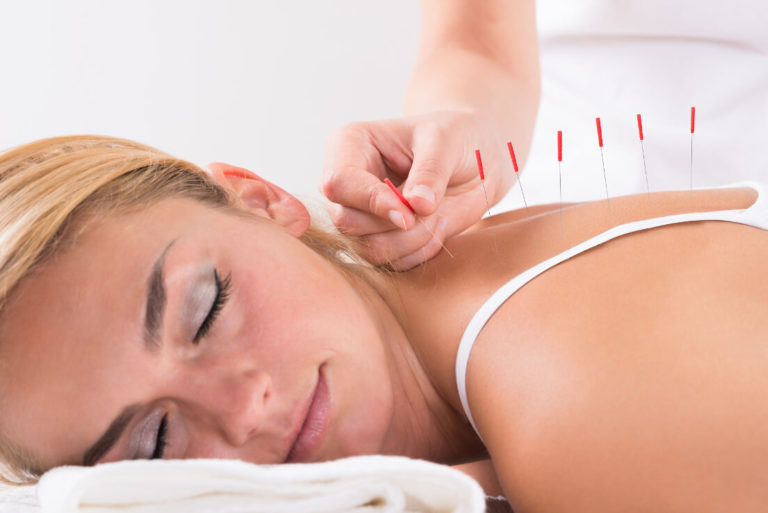 lady-getting-acupuncture